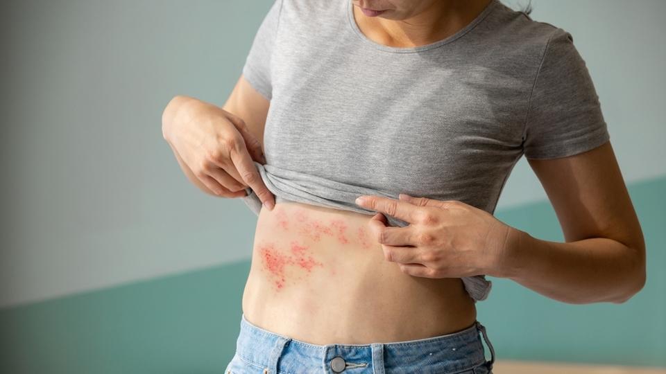 Zona, psoriasis et eczéma - Jean-Paul Salasc magnétiseur à Tourbes